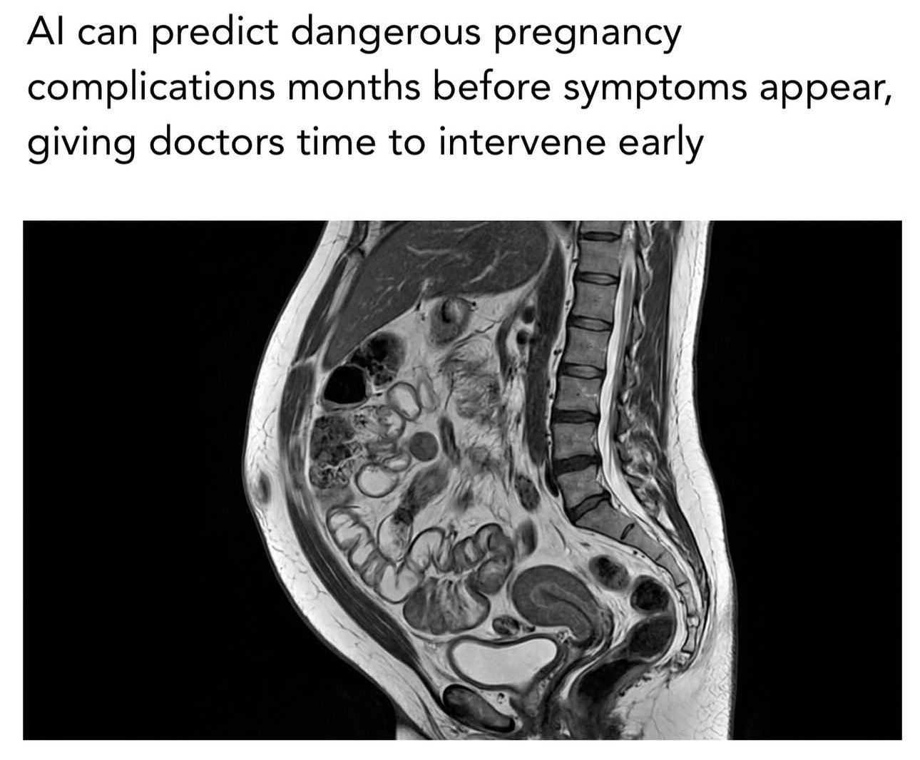 Al can
predict dangerous pregnancy
complications months before symptoms appear,
giving doctors time to intervene early